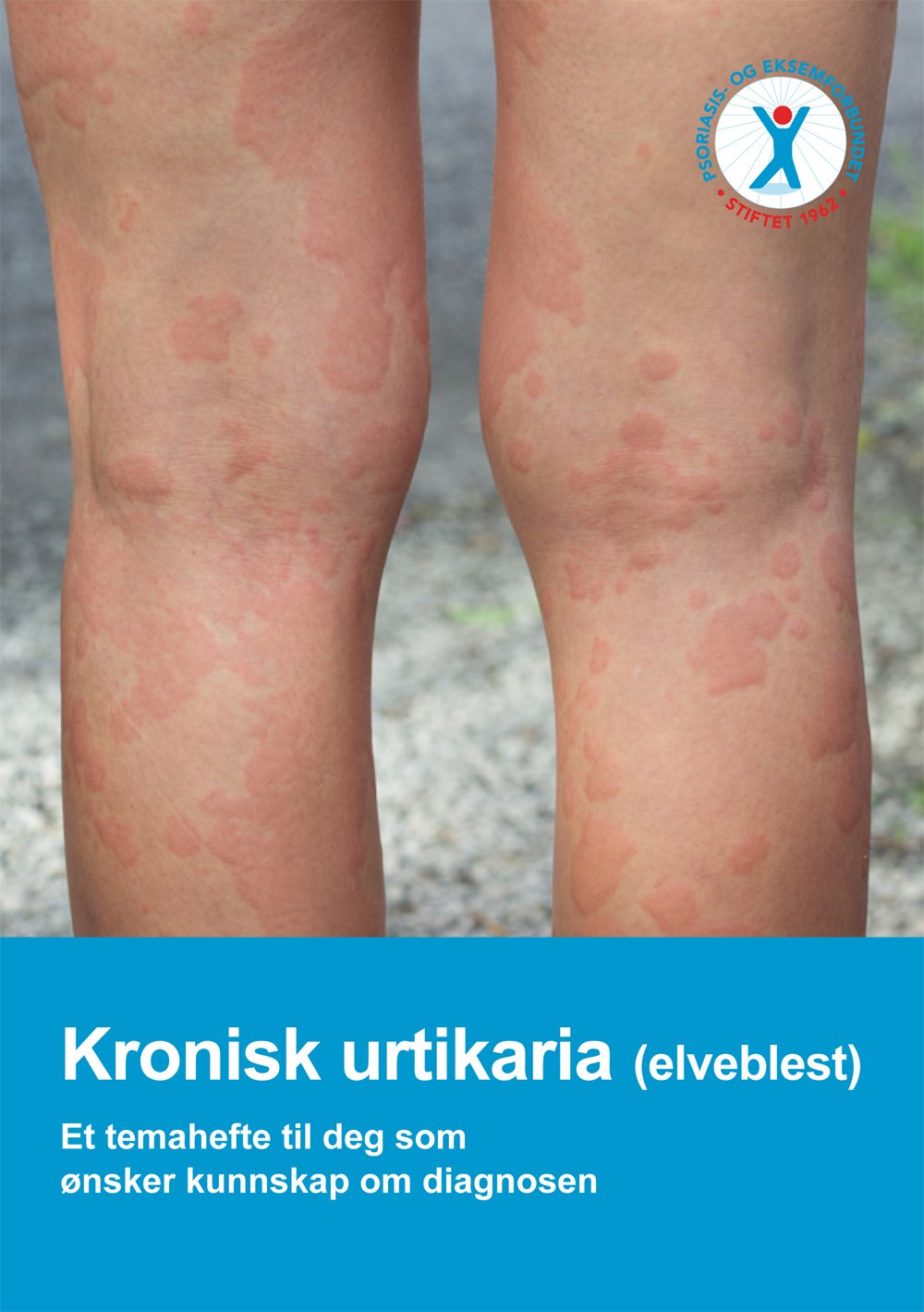 Kronisk urtikaria (elveblest)